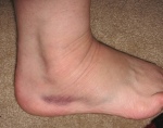 How my ankle looked...